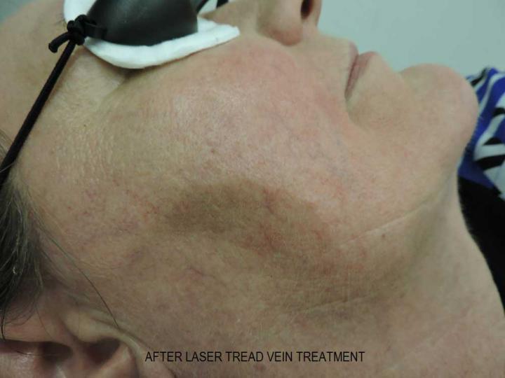 After laser thread vein treatment