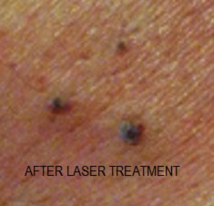 After laser treatment for blood spots