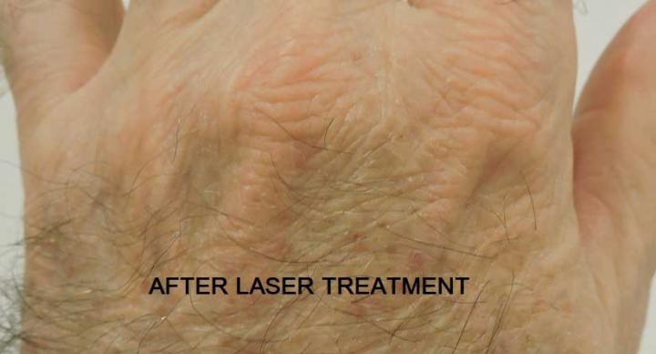 Age spots after laser treatment in Erith