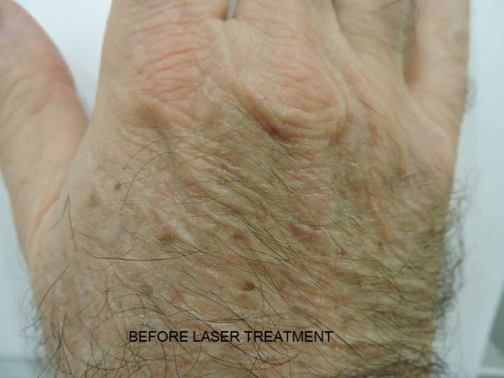 Age spots before laser treatment in Erith