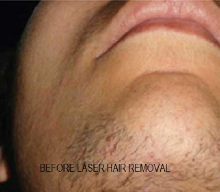 Before laser hair removal