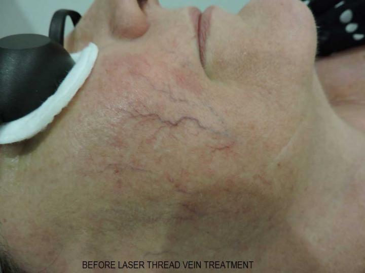 Before laser thread vein treatment