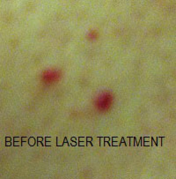 Before laser treatment for blood spots