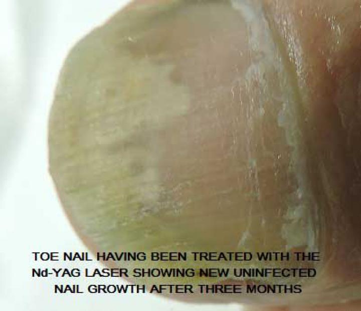 Laser nail fungus treatment in Erith, Kent