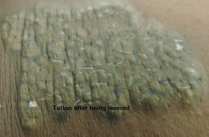 Tattoo after lasering at Erith clinic
