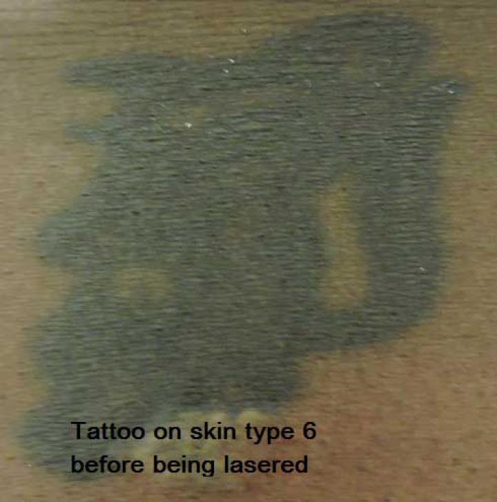 Tattoo before lasering at Erith clinic